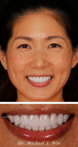 Angel W after smile makeover