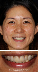 Angel W before smile makeover