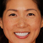 Angel W featured smile makeover NYC cosmetic dentist