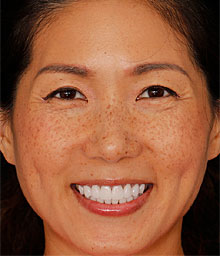 Angel W featured smile makeover NYC cosmetic dentist