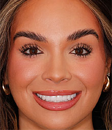 Brook W Composite After Smile Makeover 220x256D