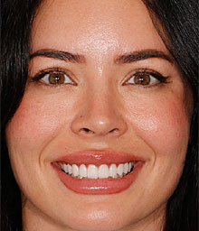 Taylor B Face After Smile Makeover 220x256
