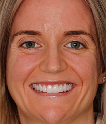 Haley B Face After Smile Makeover 220x256