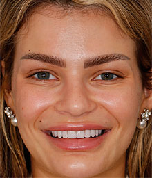Natalia L Face After Smile Makeover 220x256