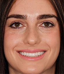 fraidy l face after smile makeover 220x256