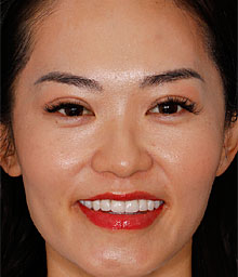 Joanne L Face After Smile Makeover 220x256