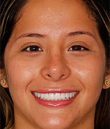 Barbara M Face After Smile Makeover 220x256