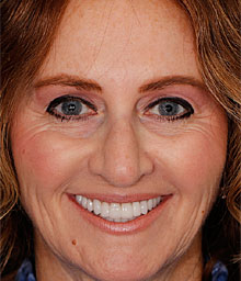 Raizy R Face After Smile Makeover 220x256